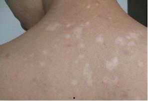 白癜风可以吃瓜么,瓜类食物的适宜与禁忌